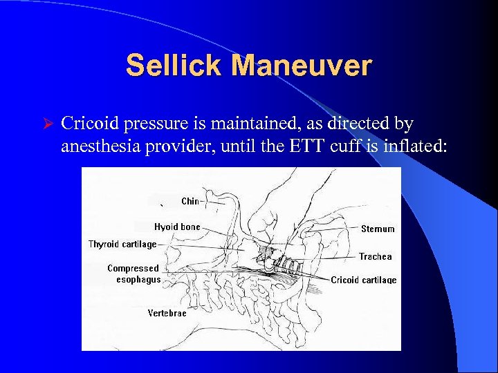 Sellick Maneuver Ø Cricoid pressure is maintained, as directed by anesthesia provider, until the