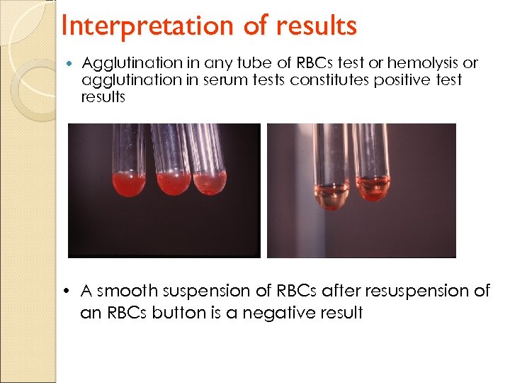 Interpretation of results Agglutination in any tube of RBCs test or hemolysis or agglutination