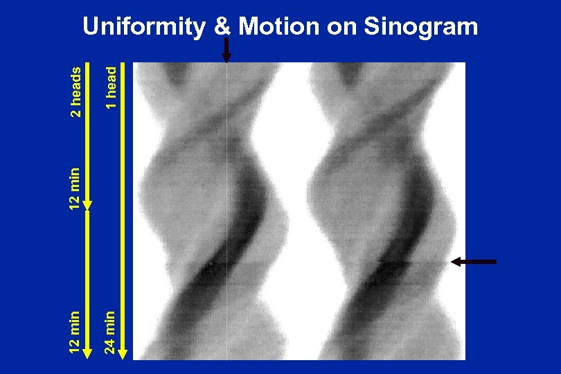 1 head 24 min 12 min 2 heads Uniformity & Motion on Sinogram 