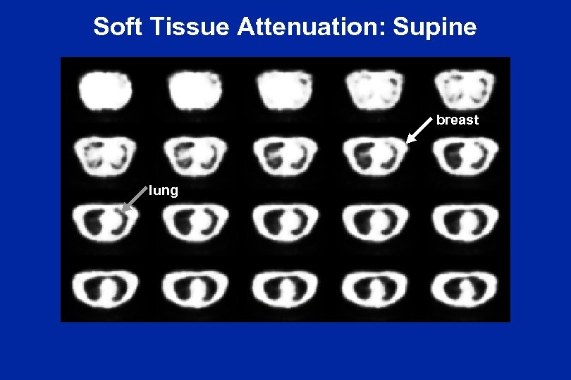 Soft Tissue Attenuation: Supine breast lung 