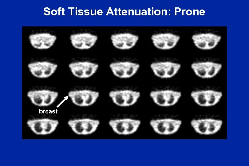 Soft Tissue Attenuation: Prone breast 