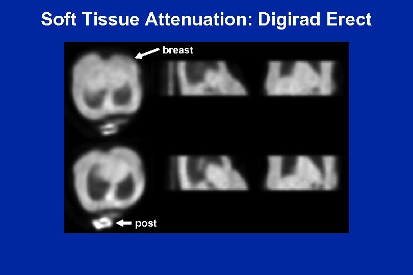 Soft Tissue Attenuation: Digirad Erect breast post 