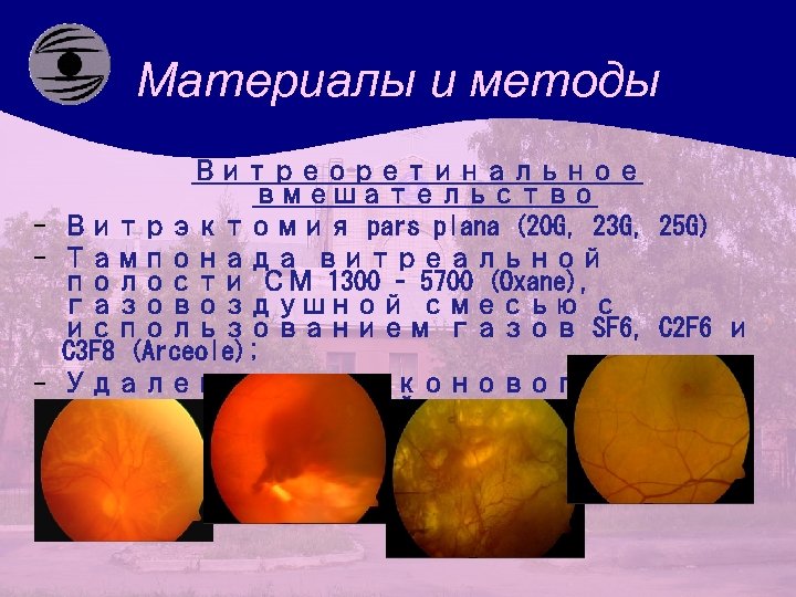 Материалы и методы Витреоретинальное вмешательство - Витрэктомия pars plana (20 G, 23 G, 25