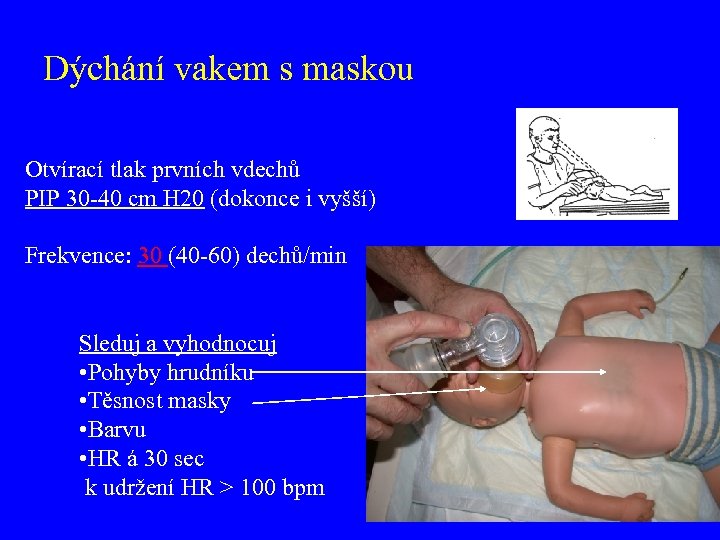 Dýchání vakem s maskou Otvírací tlak prvních vdechů PIP 30 -40 cm H 20