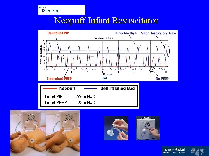 Neopuff Infant Resuscitator 