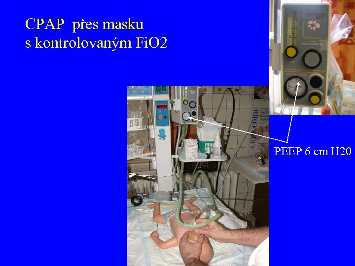 CPAP přes masku s kontrolovaným Fi. O 2 PEEP 6 cm H 20 