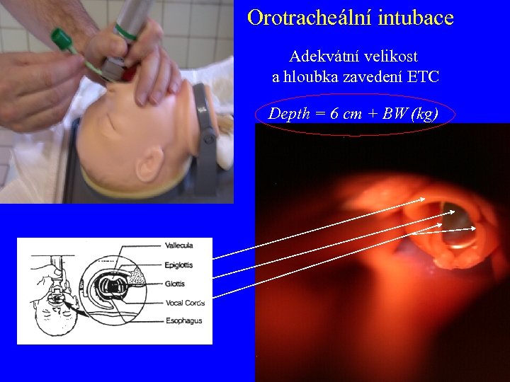 Orotracheální intubace Adekvátní velikost a hloubka zavedení ETC Depth = 6 cm + BW