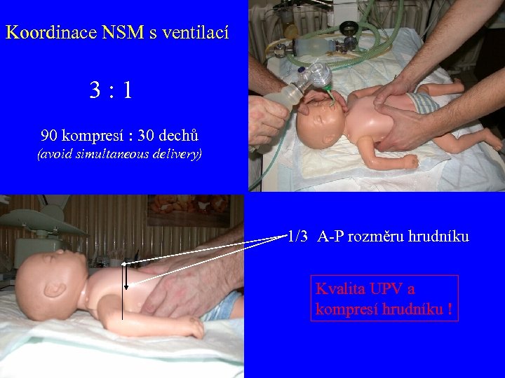 Koordinace NSM s ventilací 3: 1 90 kompresí : 30 dechů (avoid simultaneous delivery)