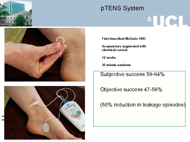 p. TENS System First described Mc. Guire 1983 Acupuncture augmented with electrical current 12
