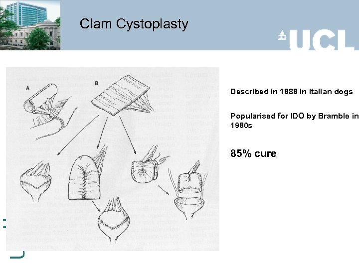 Clam Cystoplasty Described in 1888 in Italian dogs Popularised for IDO by Bramble in