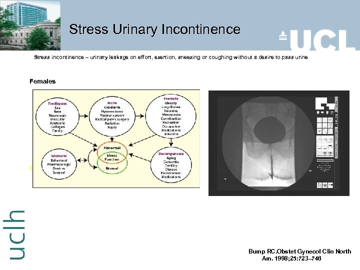 Stress Urinary Incontinence Stress incontinence – urinary leakage on effort, exertion, sneezing or coughing