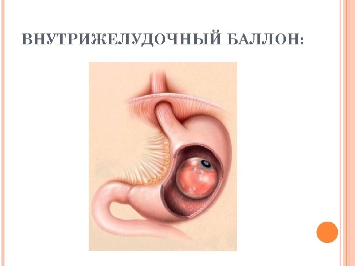 ВНУТРИЖЕЛУДОЧНЫЙ БАЛЛОН: 