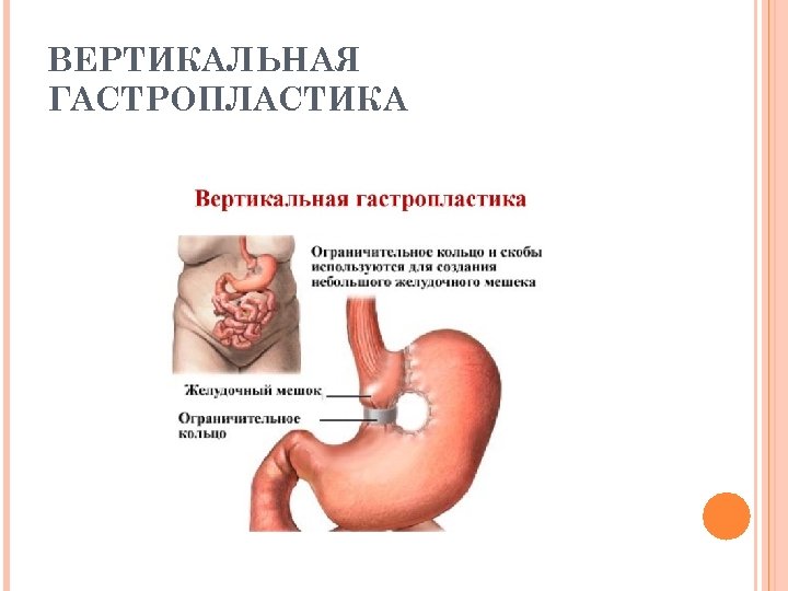 ВЕРТИКАЛЬНАЯ ГАСТРОПЛАСТИКА 