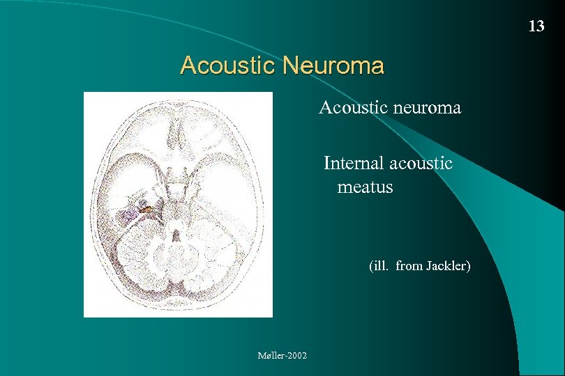 13 Acoustic Neuroma Acoustic neuroma Internal acoustic meatus (ill. from Jackler) Møller-2002 