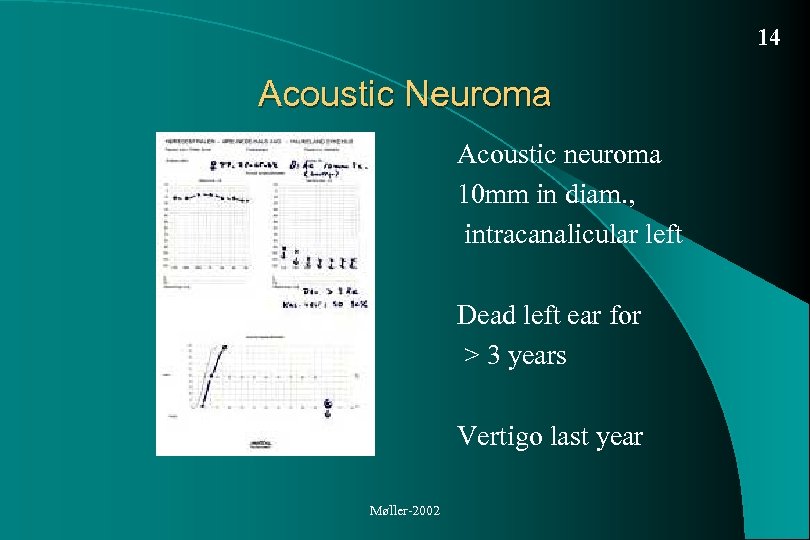 14 Acoustic Neuroma Acoustic neuroma 10 mm in diam. , intracanalicular left Dead left