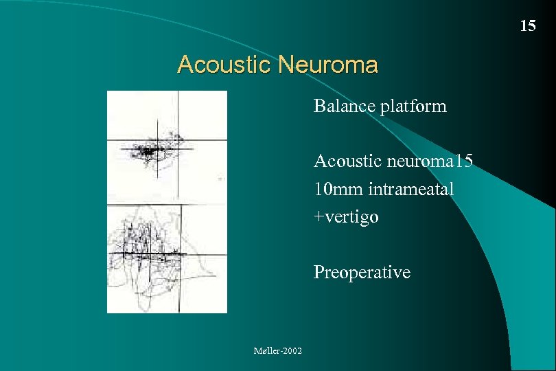 15 Acoustic Neuroma Balance platform Acoustic neuroma 15 10 mm intrameatal +vertigo Preoperative Møller-2002