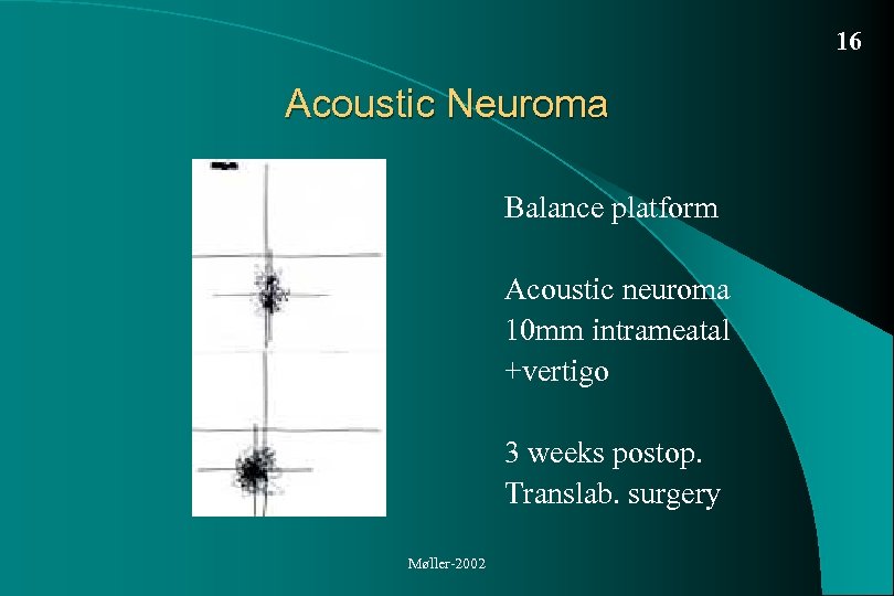 16 Acoustic Neuroma Balance platform Acoustic neuroma 10 mm intrameatal +vertigo 3 weeks postop.