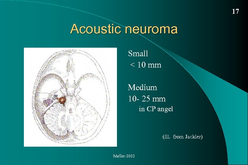 17 Acoustic neuroma Small < 10 mm Medium 10 - 25 mm in CP