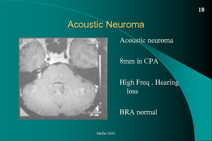 18 Acoustic Neuroma Acoustic neuroma 8 mm in CPA High Freq. Hearing loss BRA