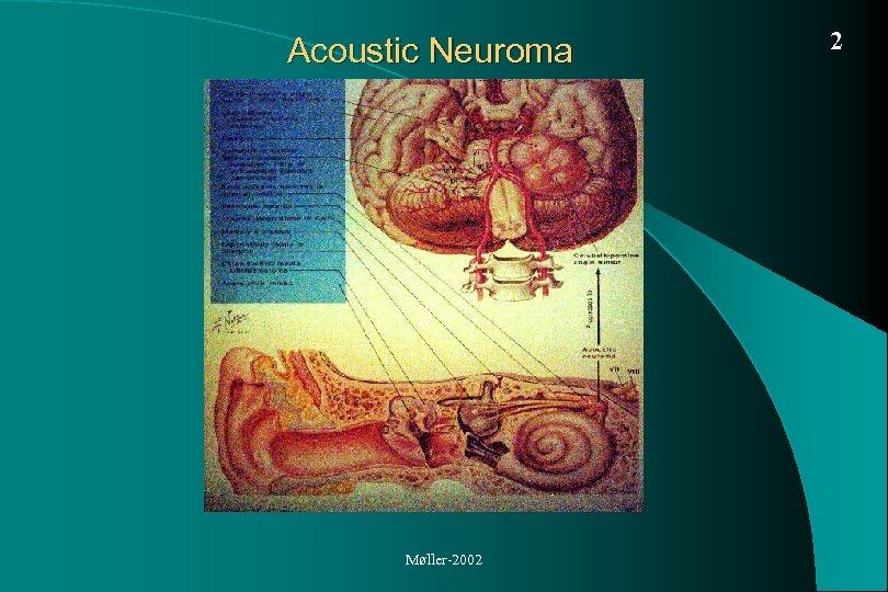 Acoustic Neuroma Møller-2002 2 