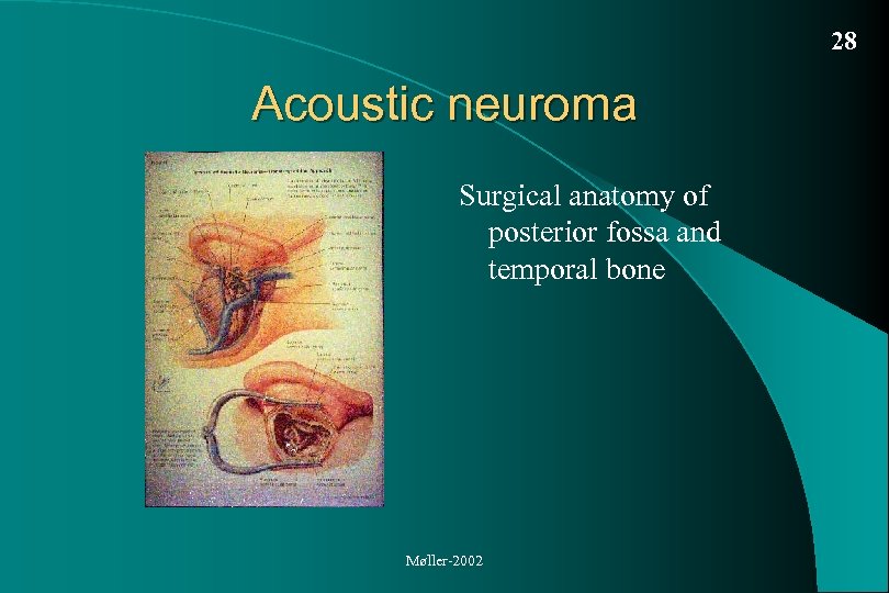 28 Acoustic neuroma Surgical anatomy of posterior fossa and temporal bone Møller-2002 