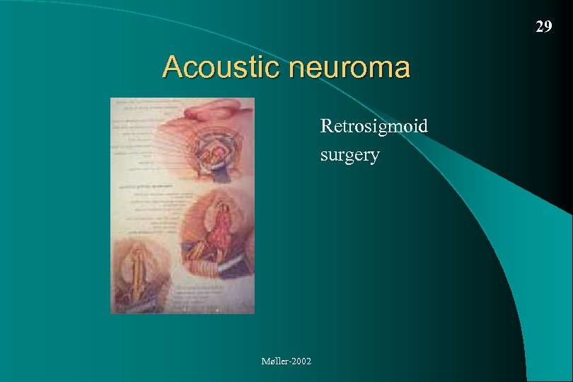 29 Acoustic neuroma Retrosigmoid surgery Møller-2002 