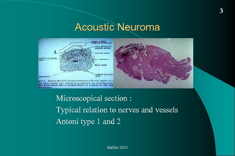 3 Acoustic Neuroma Microscopical section : Typical relation to nerves and vessels Antoni type