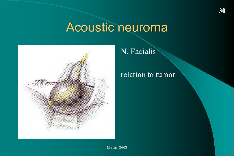 30 Acoustic neuroma N. Facialis relation to tumor Møller-2002 