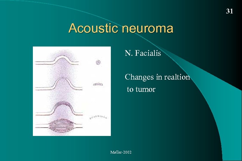 31 Acoustic neuroma N. Facialis Changes in realtion to tumor Møller-2002 