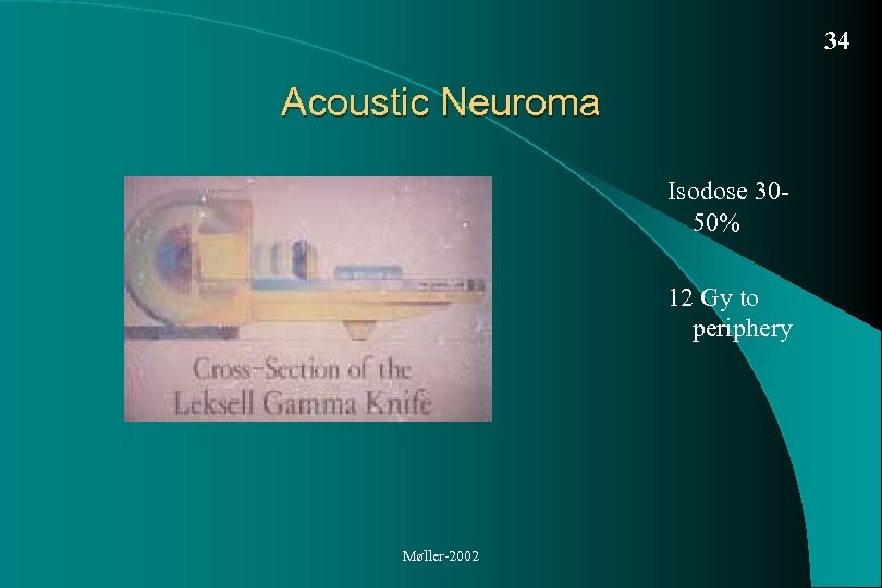 34 Acoustic Neuroma Isodose 3050% 12 Gy to periphery Møller-2002 