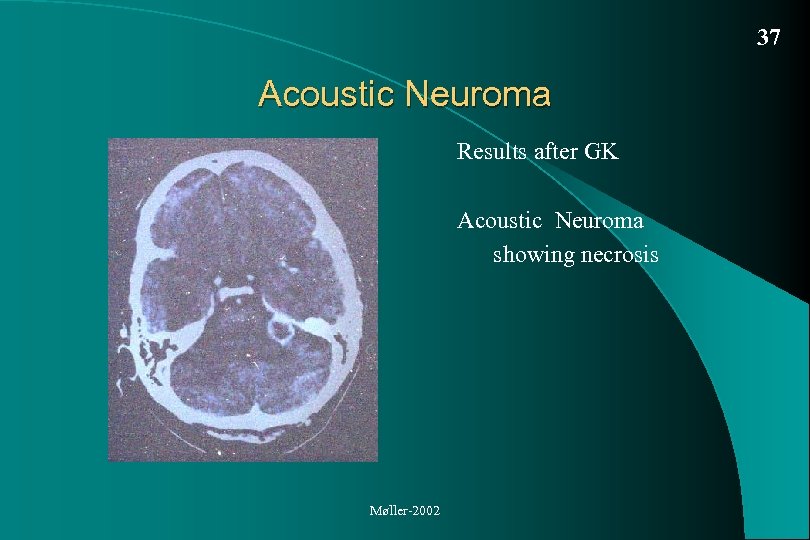 37 Acoustic Neuroma Results after GK Acoustic Neuroma showing necrosis Møller-2002 