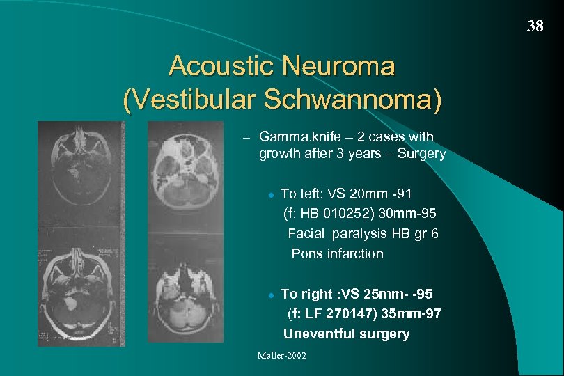 38 Acoustic Neuroma (Vestibular Schwannoma) – Gamma. knife – 2 cases with growth after