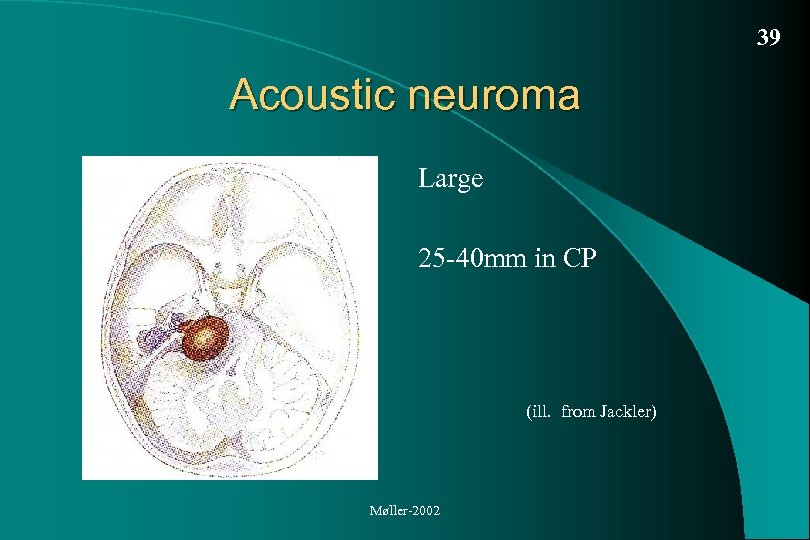 39 Acoustic neuroma Large 25 -40 mm in CP (ill. from Jackler) Møller-2002 