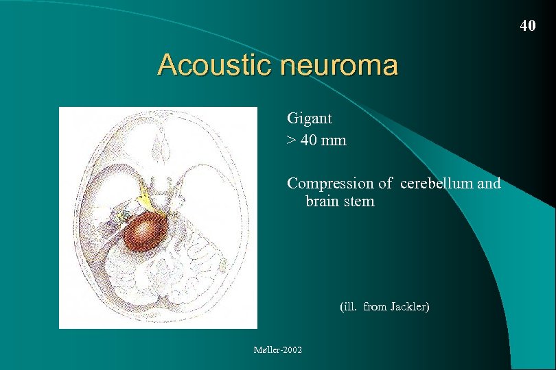 40 Acoustic neuroma Gigant > 40 mm Compression of cerebellum and brain stem (ill.