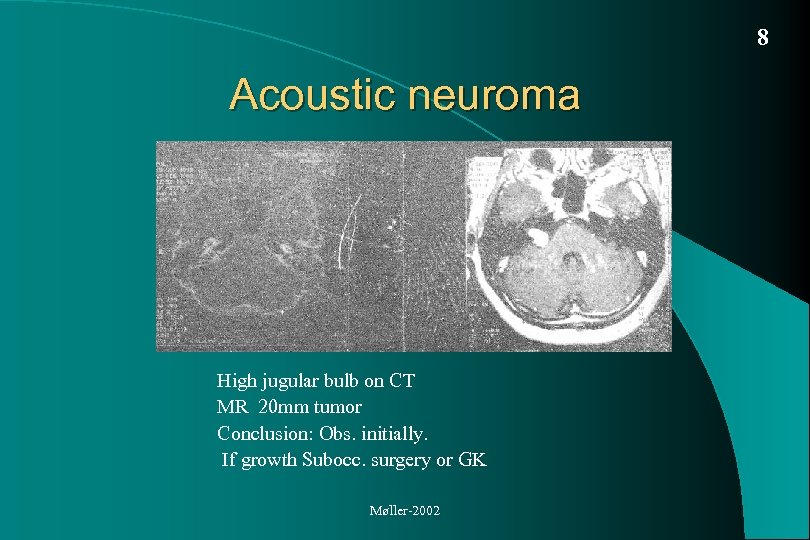 8 Acoustic neuroma High jugular bulb on CT MR 20 mm tumor Conclusion: Obs.