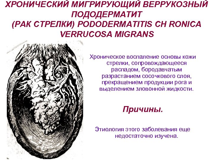 ХРОНИЧЕСКИЙ МИГРИРУЮЩИЙ ВЕРРУКОЗНЫЙ ПОДОДЕРМАТИТ (РАК СТРЕЛКИ) PODODERMATITIS CH RONICA VERRUCOSA MIGRANS Хроническое воспаление основы