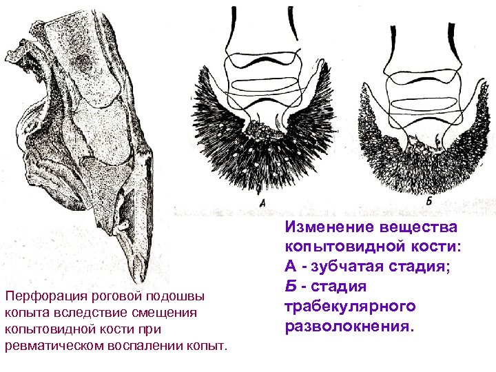 Перфорация роговой подошвы копыта вследствие смещения копытовидной кости при ревматическом воспалении копыт. Изменение вещества