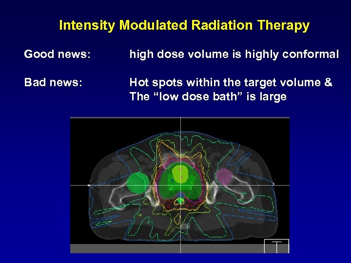 Intensity Modulated Radiation Therapy Good news: high dose volume is highly conformal Bad news: