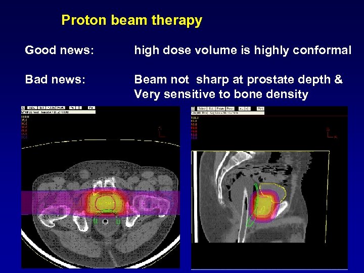 Proton beam therapy Good news: high dose volume is highly conformal Bad news: Beam