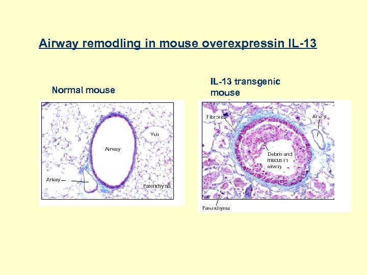 Airway remodling in mouse overexpressin IL-13 Normal mouse IL-13 transgenic mouse 