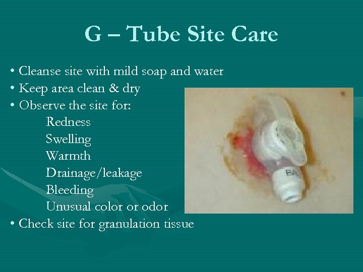 G – Tube Site Care • Cleanse site with mild soap and water •