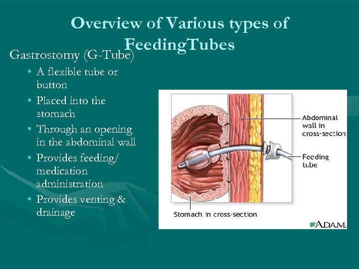 Specialized G J Tube Training Developed According To Map