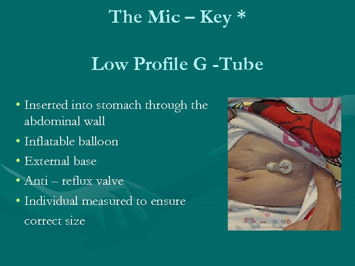 The Mic – Key * Low Profile G -Tube • Inserted into stomach through