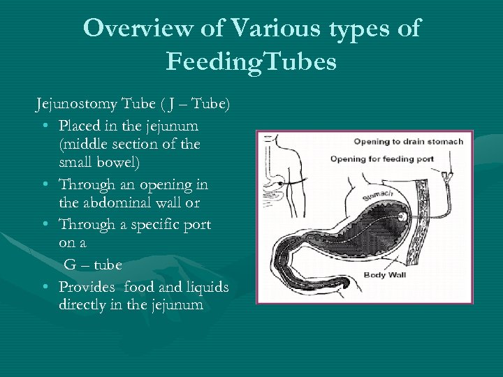 Specialized G J Tube Training Developed according to MAP