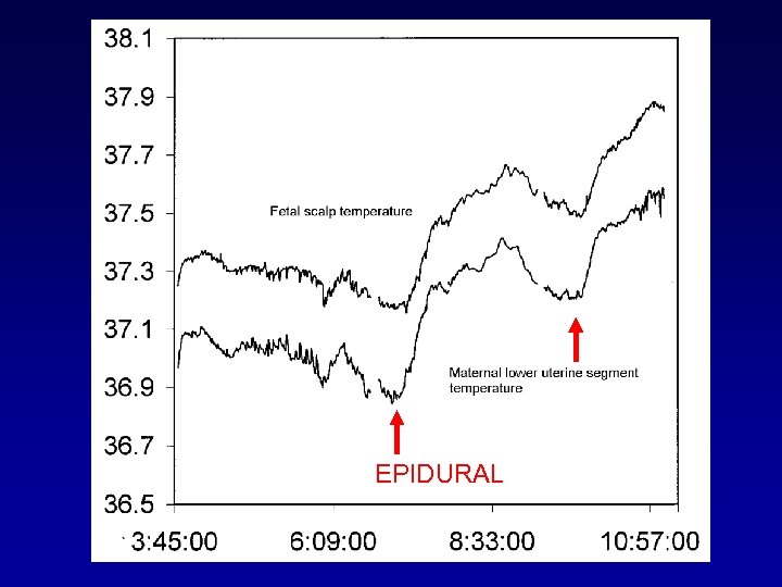 EPIDURAL 