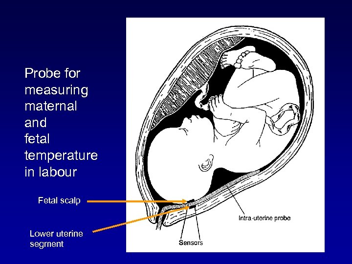 Probe for measuring maternal and fetal temperature in labour Fetal scalp Lower uterine segment