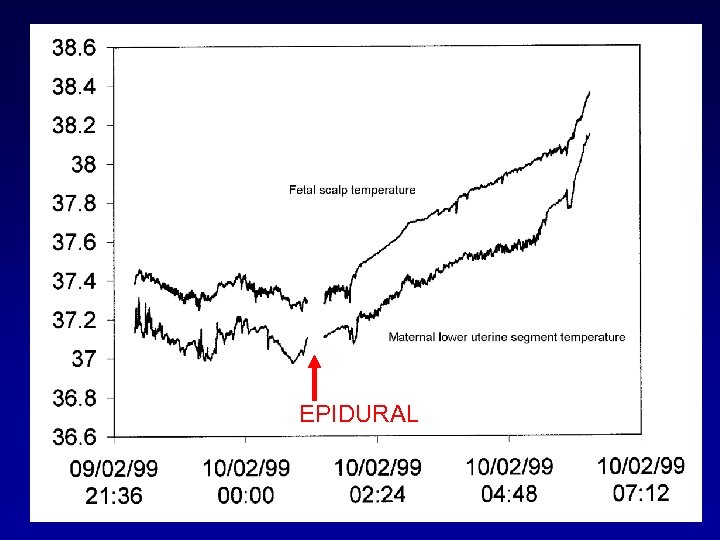 EPIDURAL 