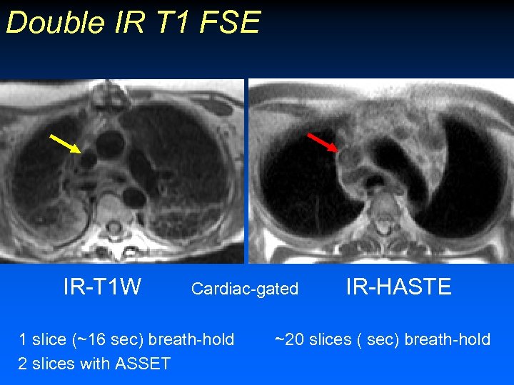 Double IR T 1 FSE IR-T 1 W Cardiac-gated 1 slice (~16 sec) breath-hold