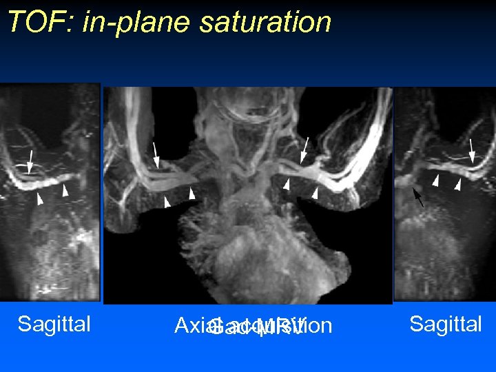 TOF: in-plane saturation Sagittal Axial acquisition Gad-MRV Sagittal 