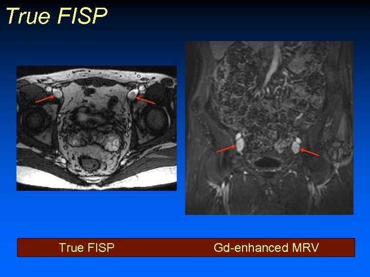 True FISP Gd-enhanced MRV 